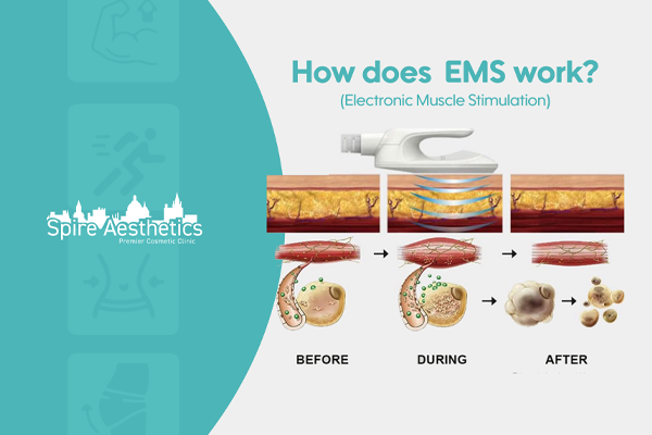 EMS treatment for post pregnancy weight loss treatment Ayr