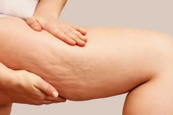 Image of woman showing leg with cellulite Ayr