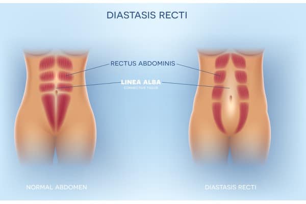 How Does Non-Surgical Treatment Help With Loose Skin, Weak Abdominal Muscles and Post-Pregnancy Changes Ayr?