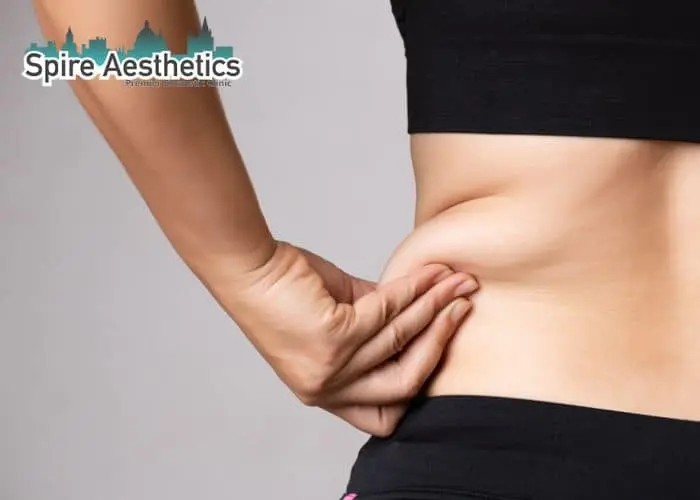 Image of woman pinching fat on their hips Ayr. Fat Freezing treatment