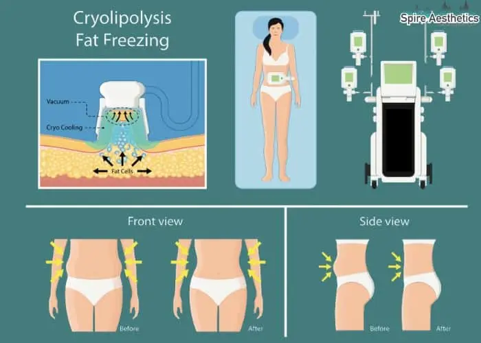 Fat freezing treatment Ayr benefits for competitions to remove stubborn fat deposits.