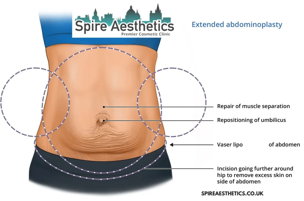 Understanding Loose Skin After Gastric Band Ayr Surgery and HIFU Treatment