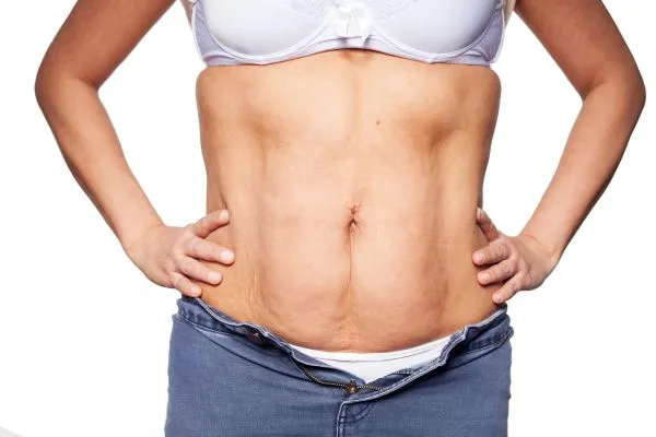 sagging skin on woman's stomach after weight loss injections Ayr