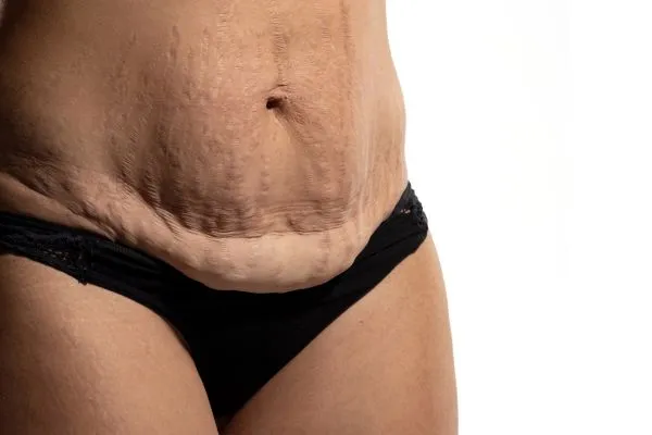 Image of womans stomach after weight loss injections Ayr showing saggy skin