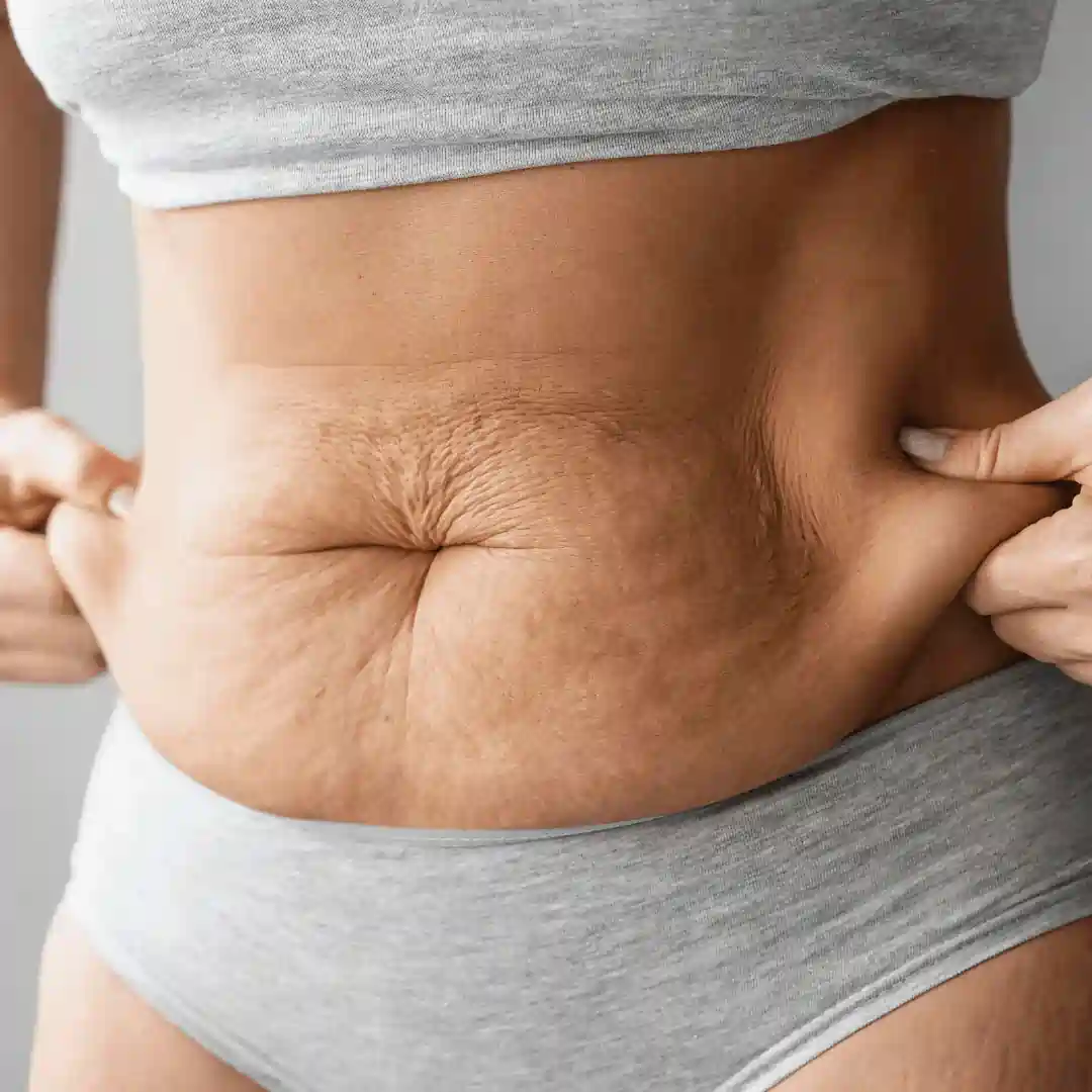 Is It Normal to Have Loose Skin After Pregnancy Ayr?