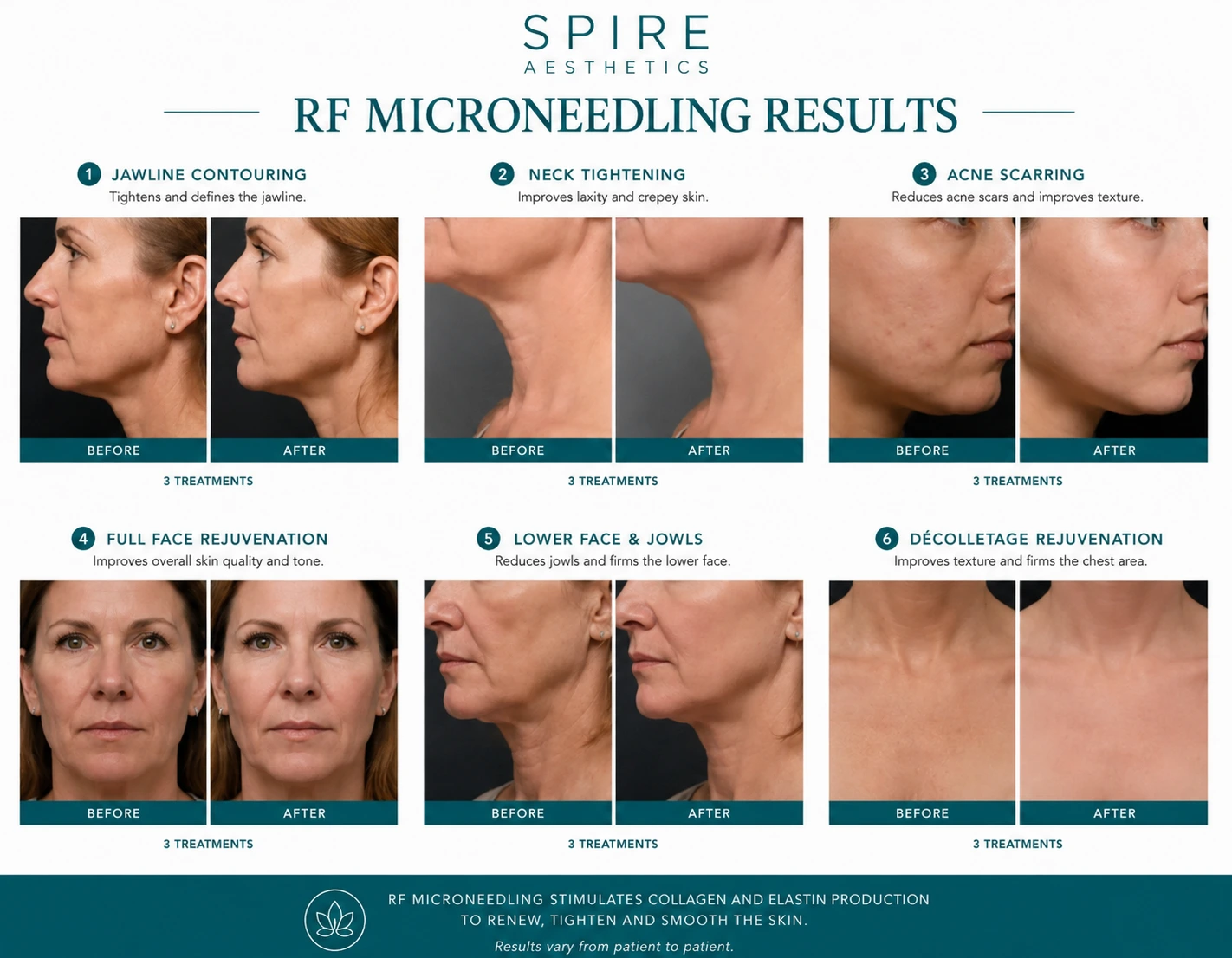 RF Microneedling Skin tightening Ayr results
