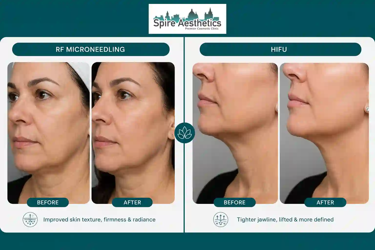 Can RF Microneedling and HIFU Be Combined Ayr?