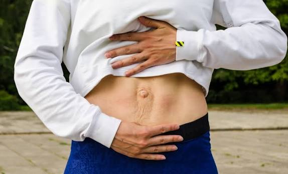 When Could Diastasis Recti Be the Missing Piece of the Puzzle Ayr?