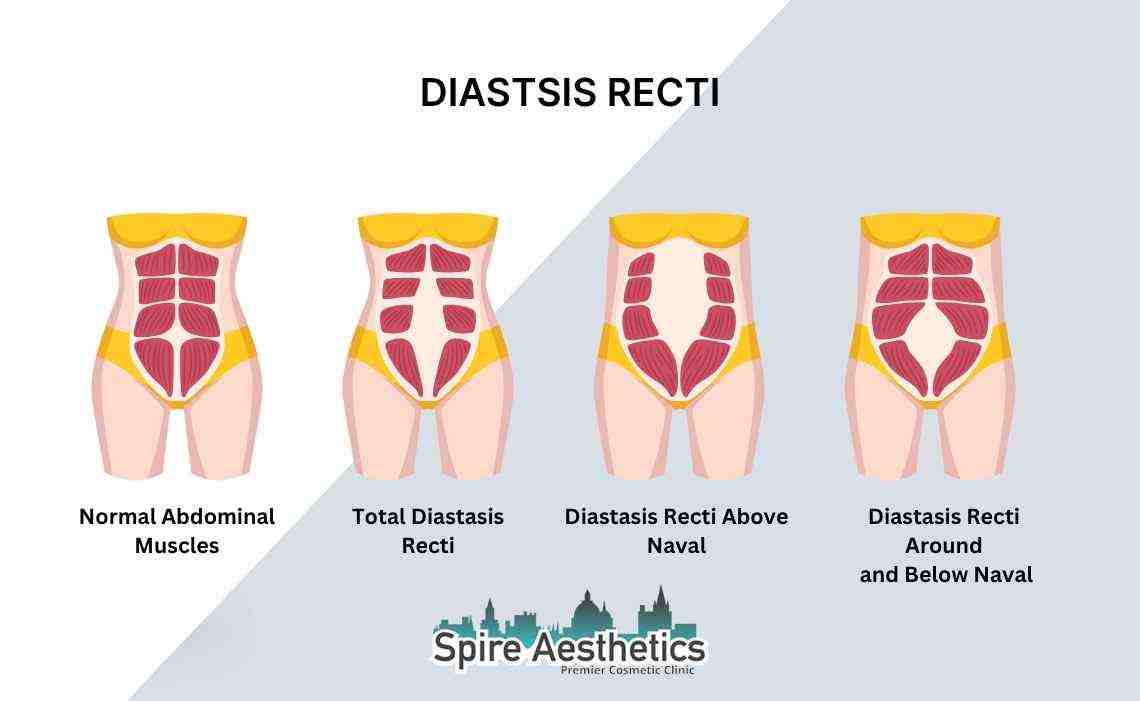 Is Non-Surgical Diastasis Recti Treatment Right for You? Common Concerns Answered Ayr
